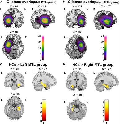 Structural and Functional Alterations in the Contralesional Medial Temporal Lobe in Glioma Patients